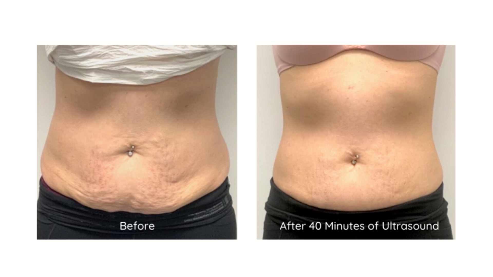 Stomach before and after 40 minutes of ultrasound contouring
