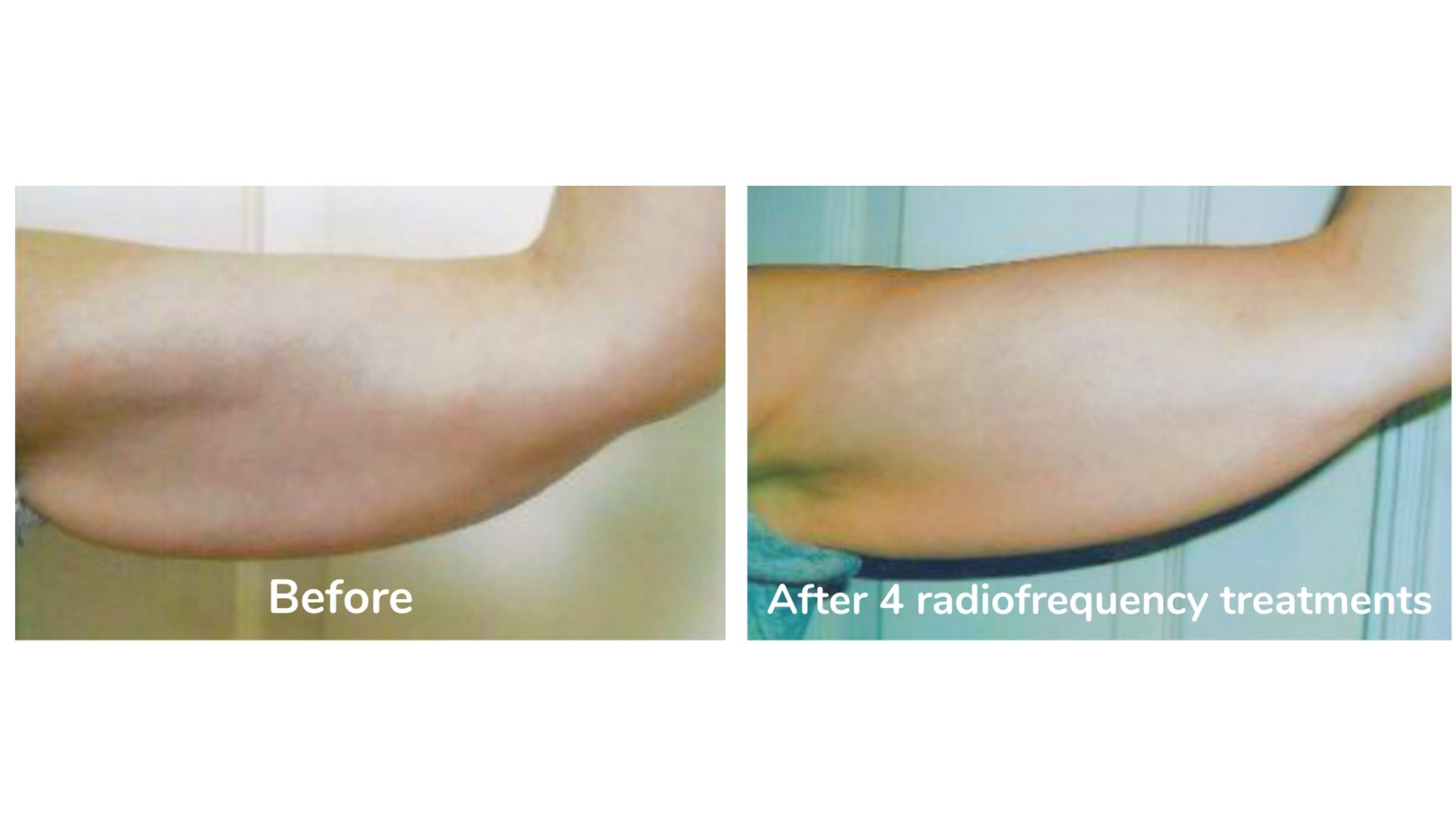 Arm before and after 4 radio frequency treatments